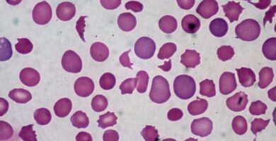 ¿Por qué se llama anemia macrocítica? ¿Por qué se llama anemia macrocítica?