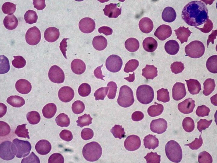 ¿Por qué se llama anemia macrocítica? ¿Por qué se llama anemia macrocítica?