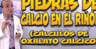 ¿Por qué se llama cálculo a la piedra del riñón?