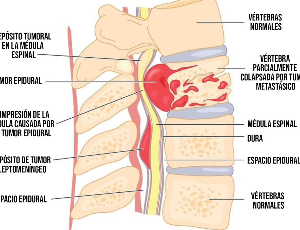 ¿Por qué se llama cáncer a la enfermedad? ¿Por qué se llama cáncer a la enfermedad?