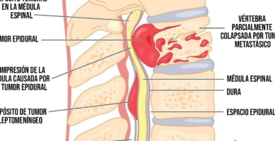 ¿Por qué se llama cáncer a la enfermedad?