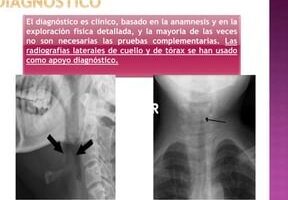 ¿Por qué se llama crup?
