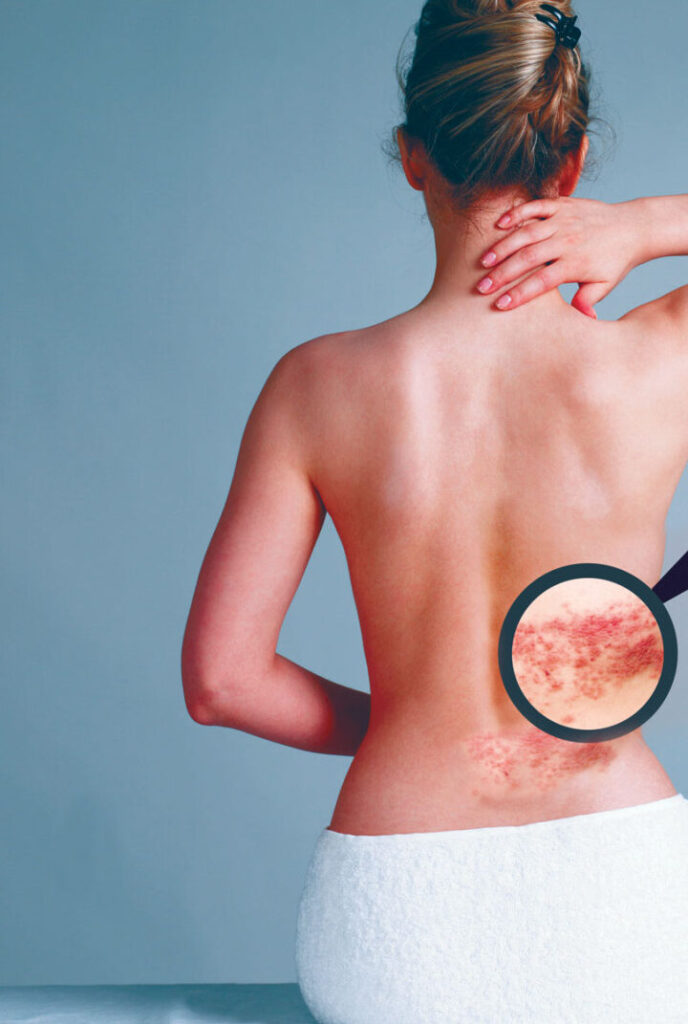 ¿Por qué se llama culebrilla? ¿Por qué se llama culebrilla?