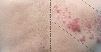 ¿Por qué se llama culebrilla al herpes?