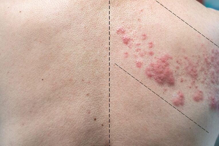 ¿Por qué se llama culebrilla al herpes?