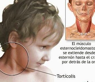 ¿Por qué se llama esternocleidomastoideo?