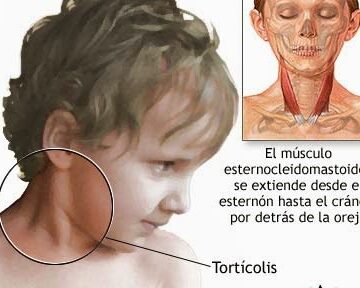 ¿Por qué se llama esternocleidomastoideo?