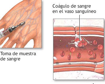 ¿Por qué se llama hemofilia? ¿Por qué se llama hemofilia?