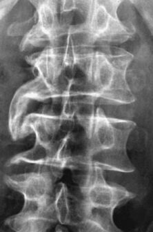 ¿Por qué se llama hiperostosis idiopática difusa? ¿Por qué se llama hiperostosis idiopática difusa?