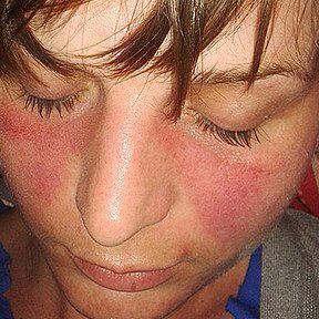 ¿Por qué se llama lupus?
