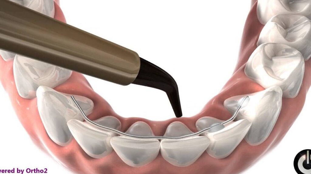 ¿Por qué se llaman brackets a los aparatos? ¿Por qué se llaman brackets a los aparatos?