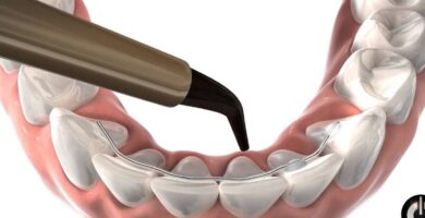 ¿Por qué se llaman brackets a los aparatos? ¿Por qué se llaman brackets a los aparatos?