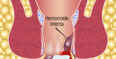 ¿Por qué se llaman hemorroides y no almorranas? ¿Por qué se llaman hemorroides y no almorranas?