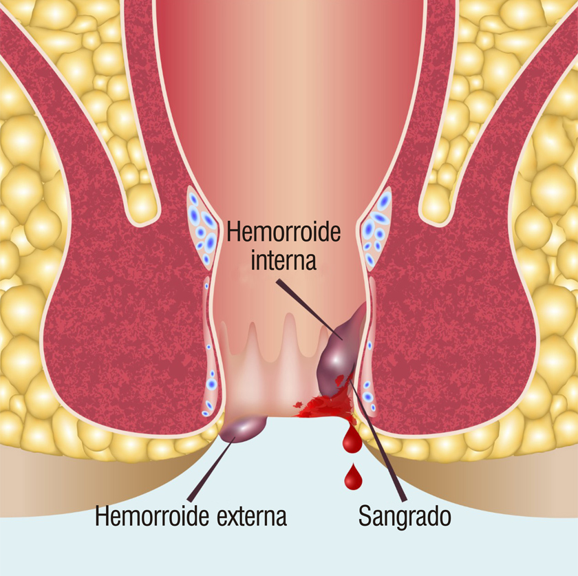 ¿Por qué se llaman hemorroides y no almorranas? ¿Por qué se llaman hemorroides y no almorranas?