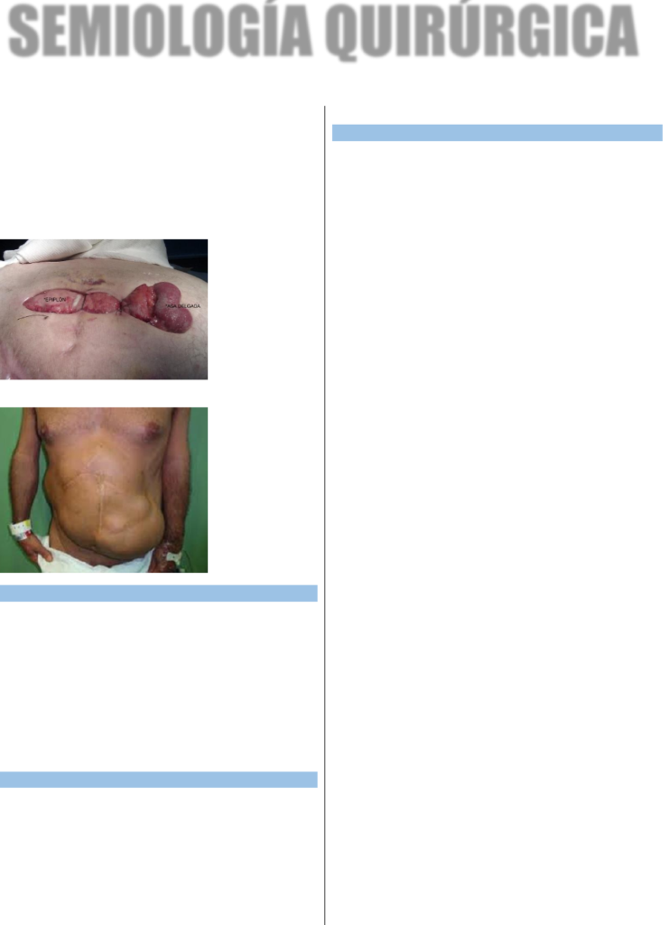 ¿Por qué se llama orificio inguinal interno? ¿Por qué se llama orificio inguinal interno?