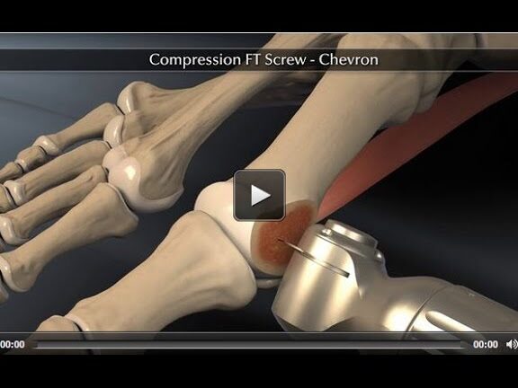 ¿Por qué se llama osteotomía de Chevron?
