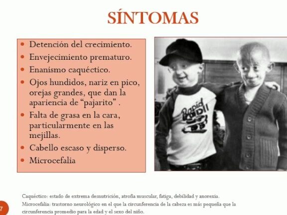 ¿Por qué se llama síndrome Cockayne? ¿Por qué se llama síndrome Cockayne?
