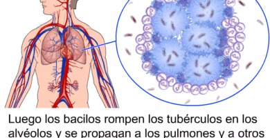 ¿Por qué se llama tuberculosis? ¿Por qué se llama tuberculosis?