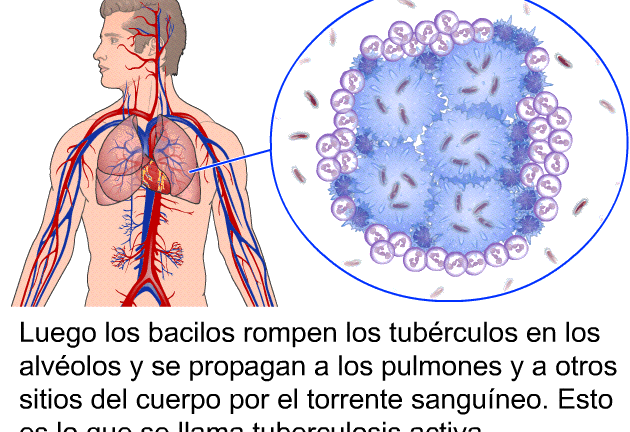 ¿Por qué se llama tuberculosis? ¿Por qué se llama tuberculosis?
